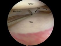 What You Need to Know About Meniscus Tear Surgery