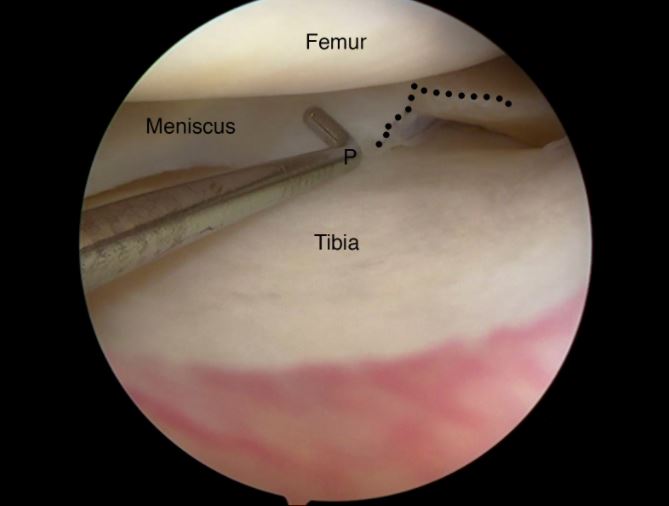 meniscus tear treatments