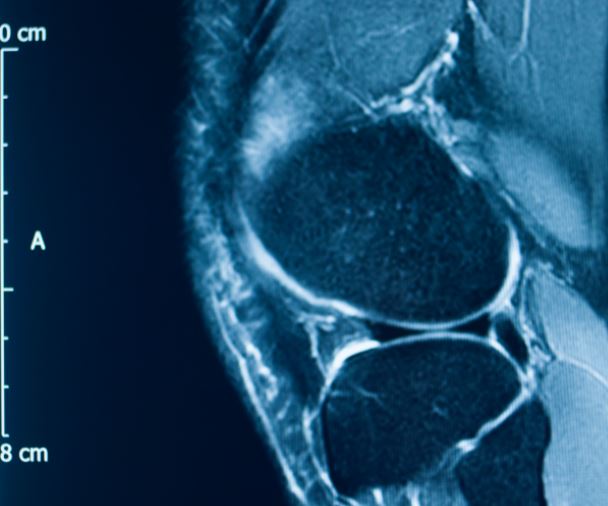 meniscus tear x-ray scan